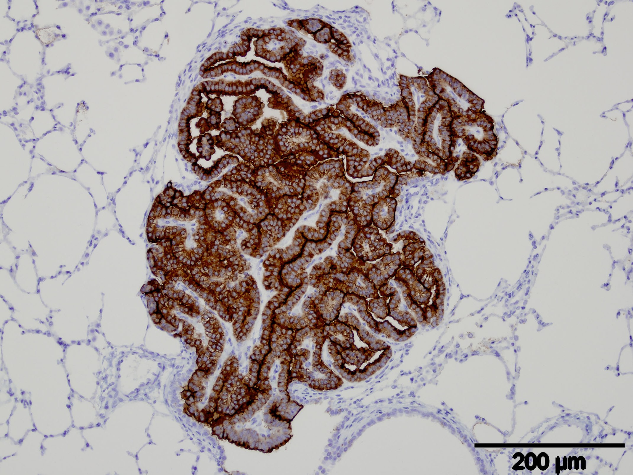 The brown staining shows new virus particles in the cancerous cells of the lung